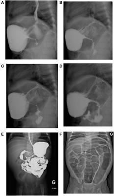 Very Early-Onset Inflammatory Manifestations of X-Linked Chronic Granulomatous Disease